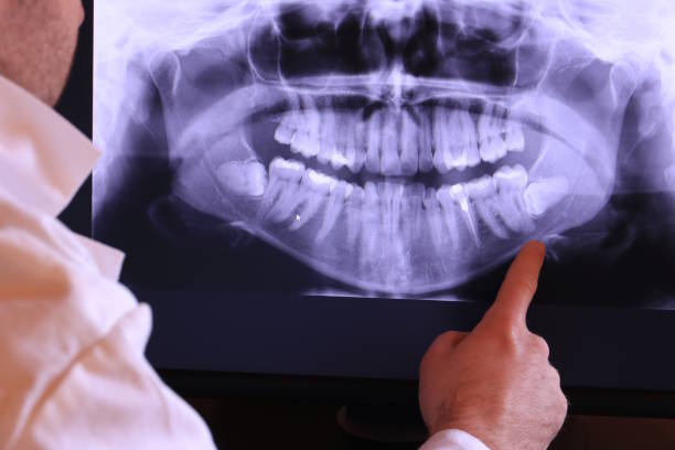 Best Urgent Care for Lost Fillings or Crowns in Wollochet, WA