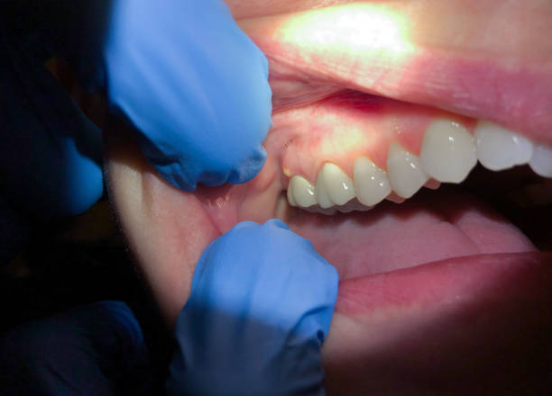 Best Emergency Treatment for Dental Infections or Abscesses in Wollochet, WA