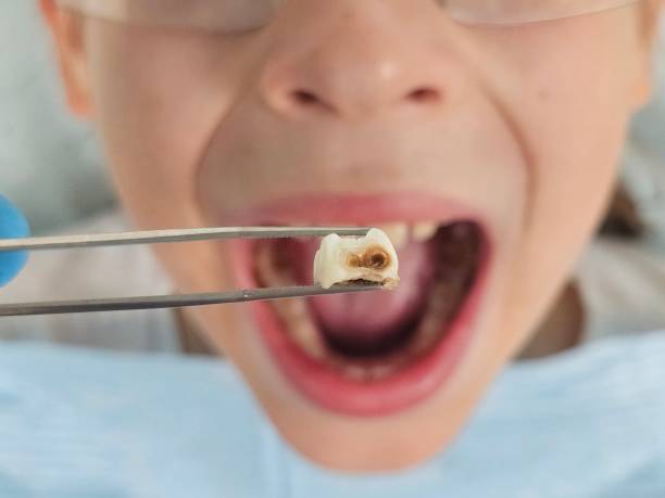 Best Emergency Tooth Extraction in Wollochet, WA